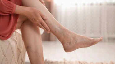 Ayurvedic Remedies for Varicose Veins