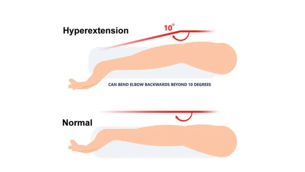 Illustration comparing a hyperextended elbow bending beyond 10 degrees with a normal elbow.