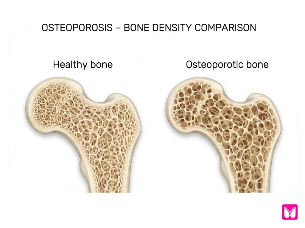 Comparison of healthy bone and osteoporotic bone showing reduced bone density in osteoporosis.